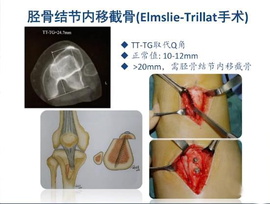 详解髌骨关节不稳定的诊断与治疗要点