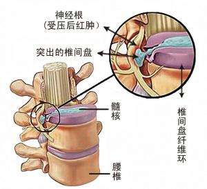 福州看腰椎间盘突出医院哪家好