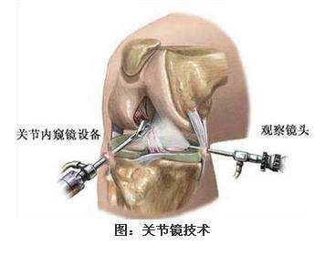 关节微创技术有效解决关节疼痛