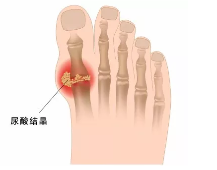 福州看痛风石去哪家医院